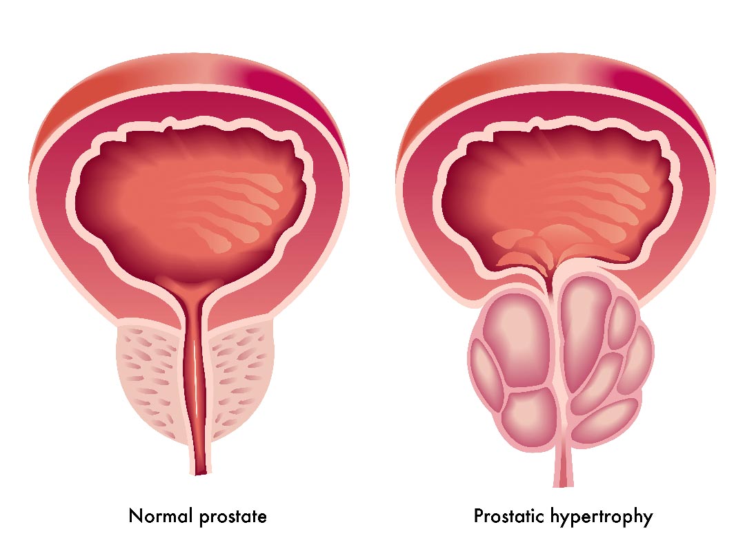controllo prostata esami ipertrofia prostatica savona